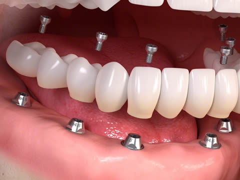 Implants su[[porting full bridge of teeth