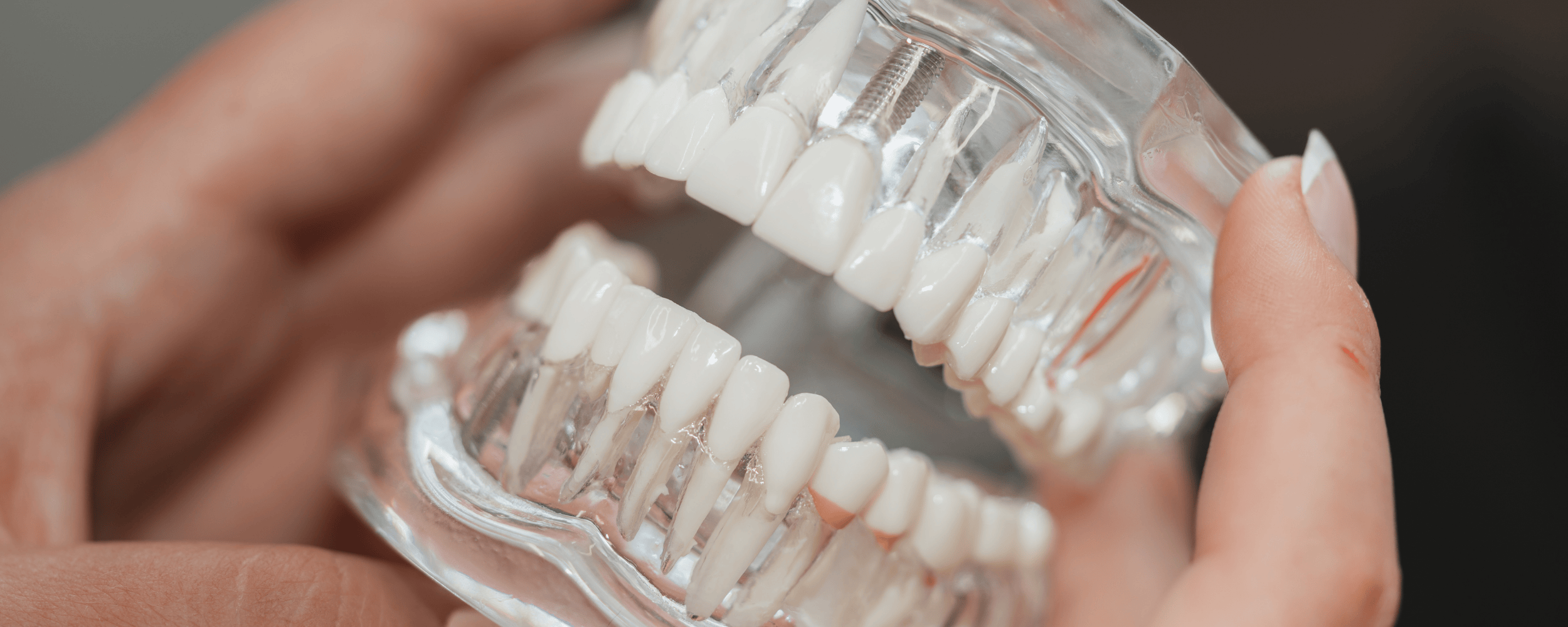 Restore Missing Teeth with Dental Implants