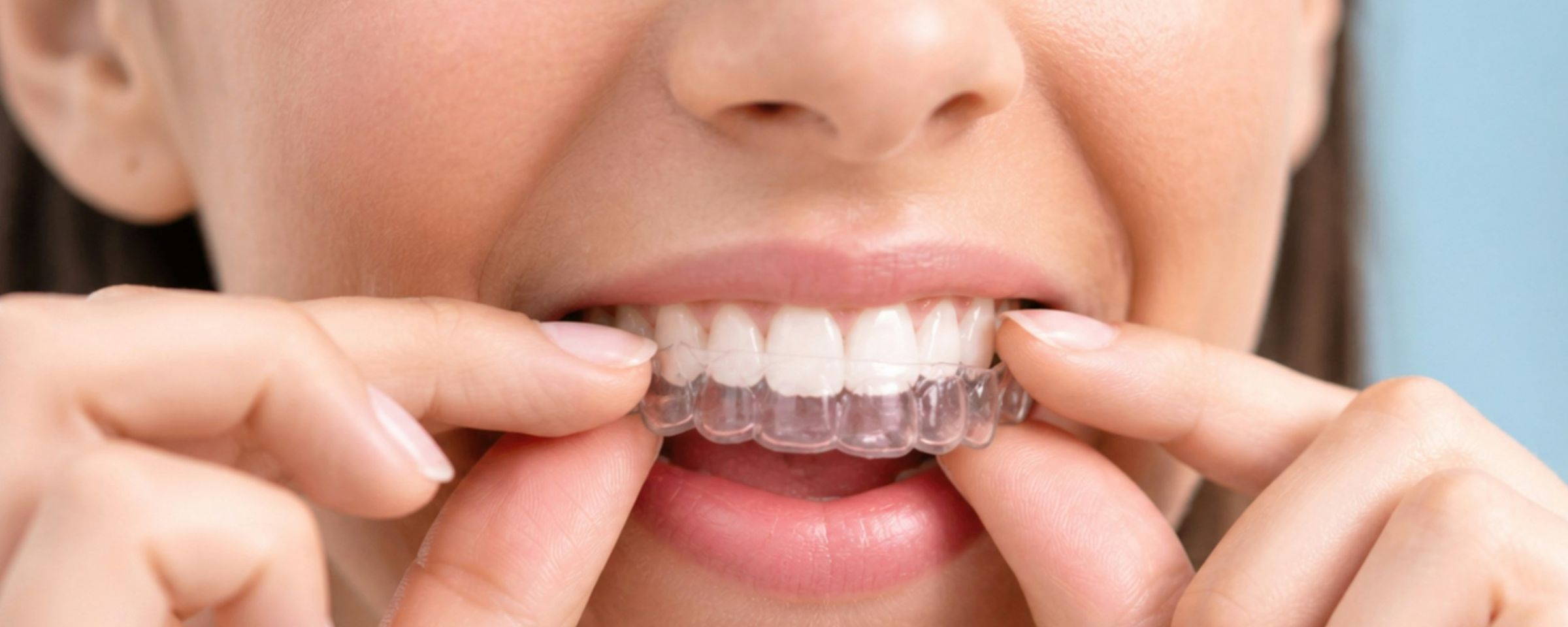 What to Expect During Invisalign Treatment: A Step-by-Step Guide
