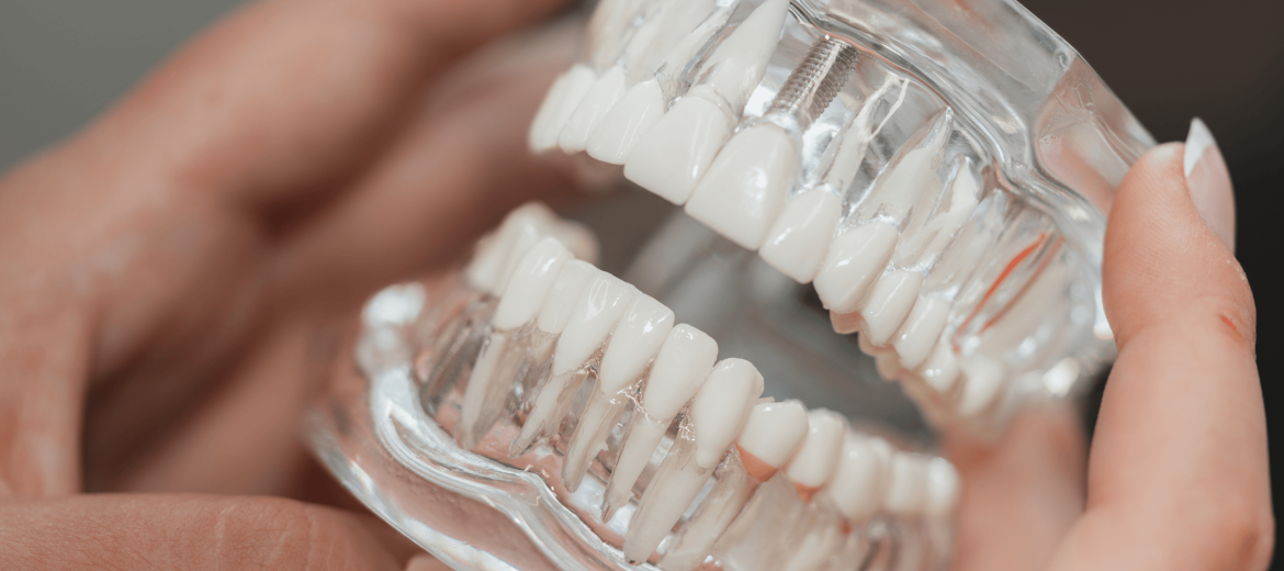 Dental Implants