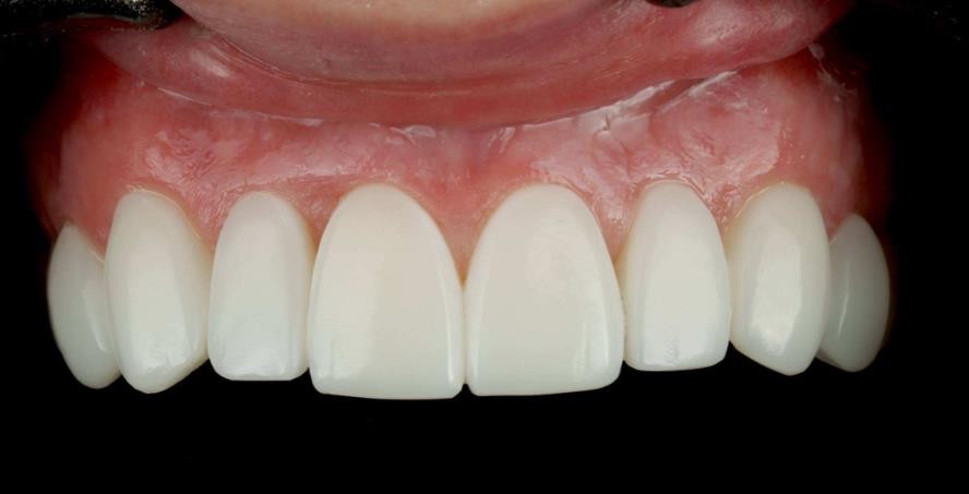Front teeth after treatment, with even lengths, closed gaps and a brighter, more uniform smile