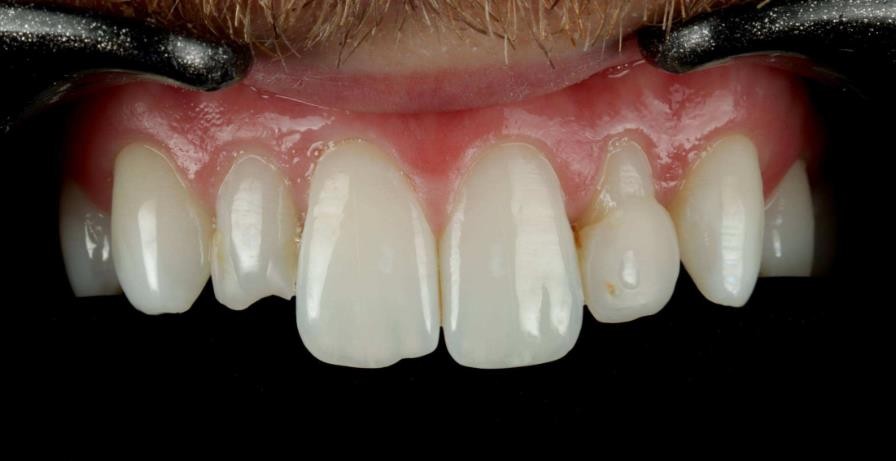Front teeth before treatment, showing chipped edges, uneven lengths and small gaps